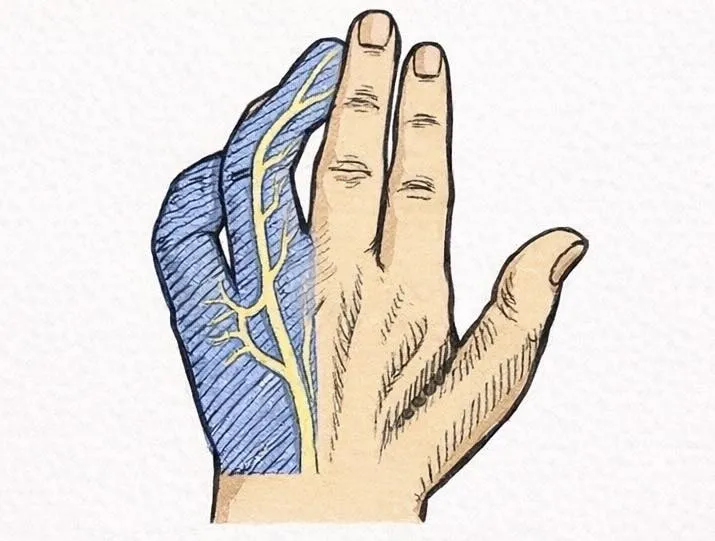 肘隧道症候群 (Cubital Tunnel Syndrome)【台北中醫診所】【中正區肌肉痠痛針灸】