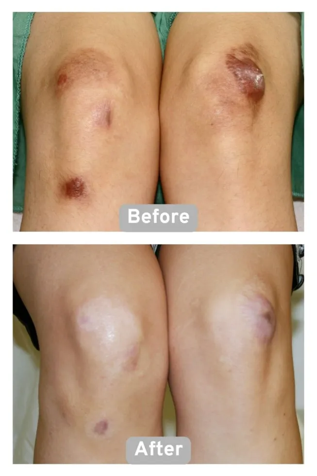 I2PL 脈衝光雷射