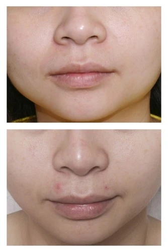 肉毒桿菌注射 (美國保妥適Botox, 英國皇家)