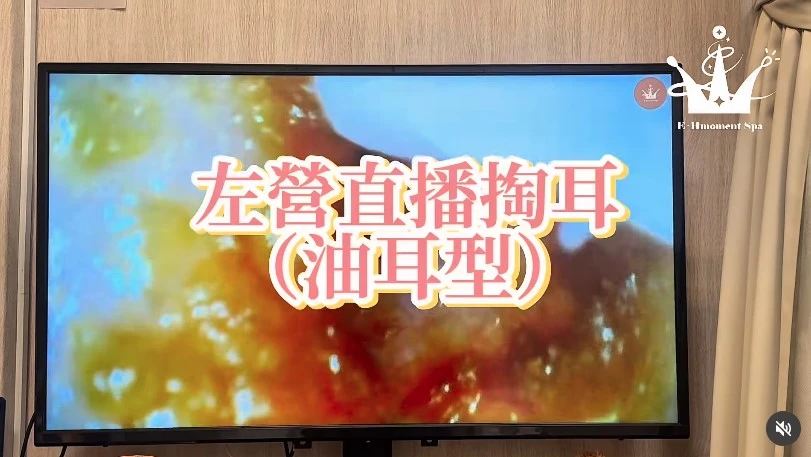 【掏耳實錄｜油耳型】
