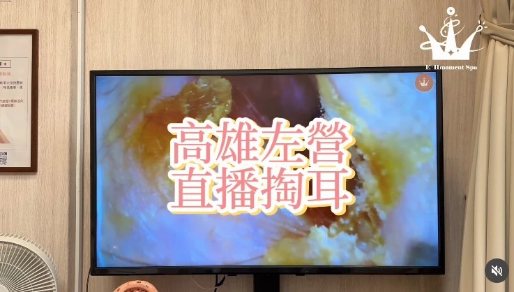 【掏耳實錄｜乾耳型】