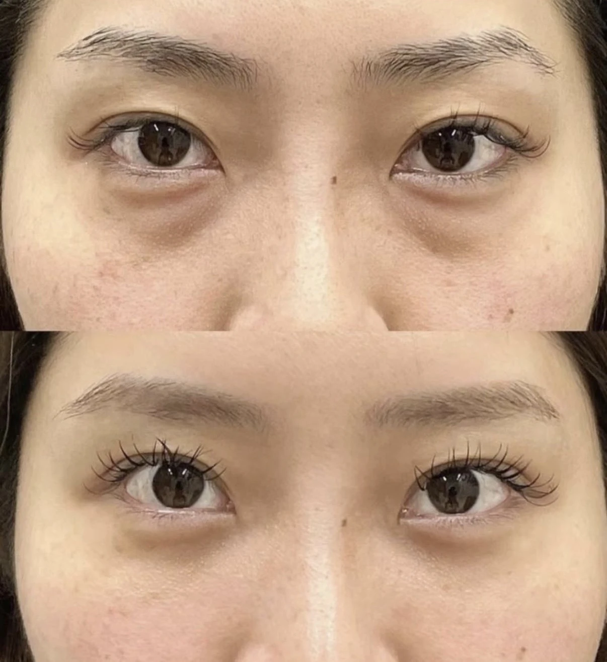 38歲 做V臉矯正術