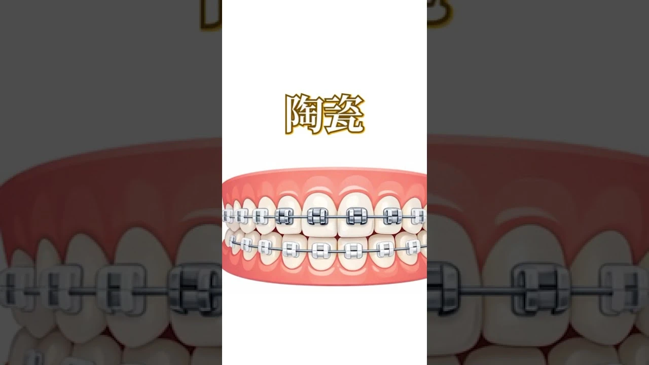 【矯正方式-Dr李牧謙】「醫師，我到底適合戴傳統牙套還是隱形牙套？」