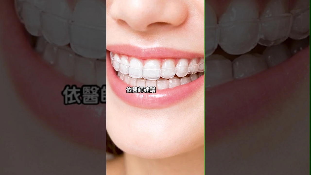 【矯正完維持器-Dr李牧謙】「矯正完成不是終點，守住整齊才是關鍵。」