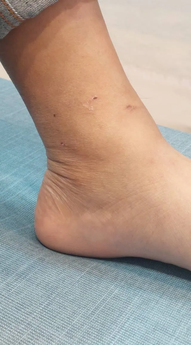 腳踝舊傷鬆筋