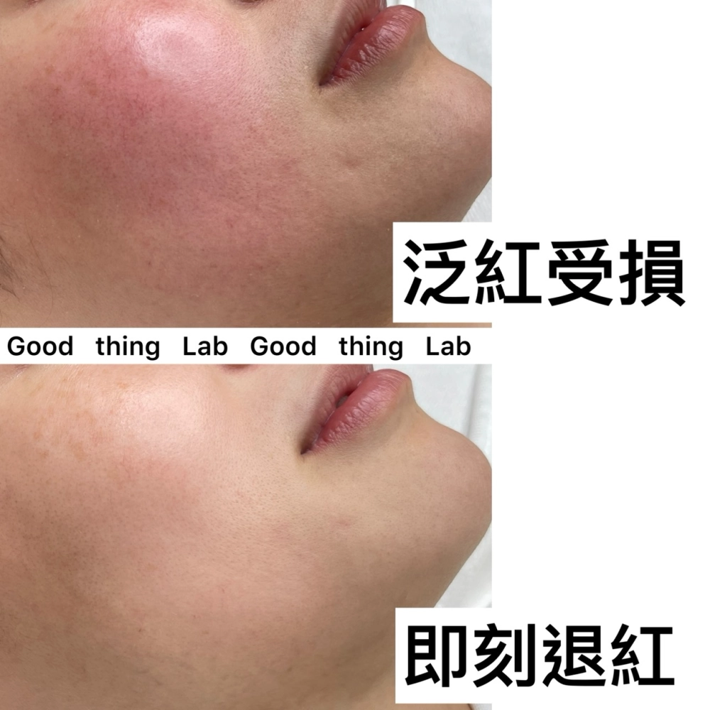 泛紅敏感