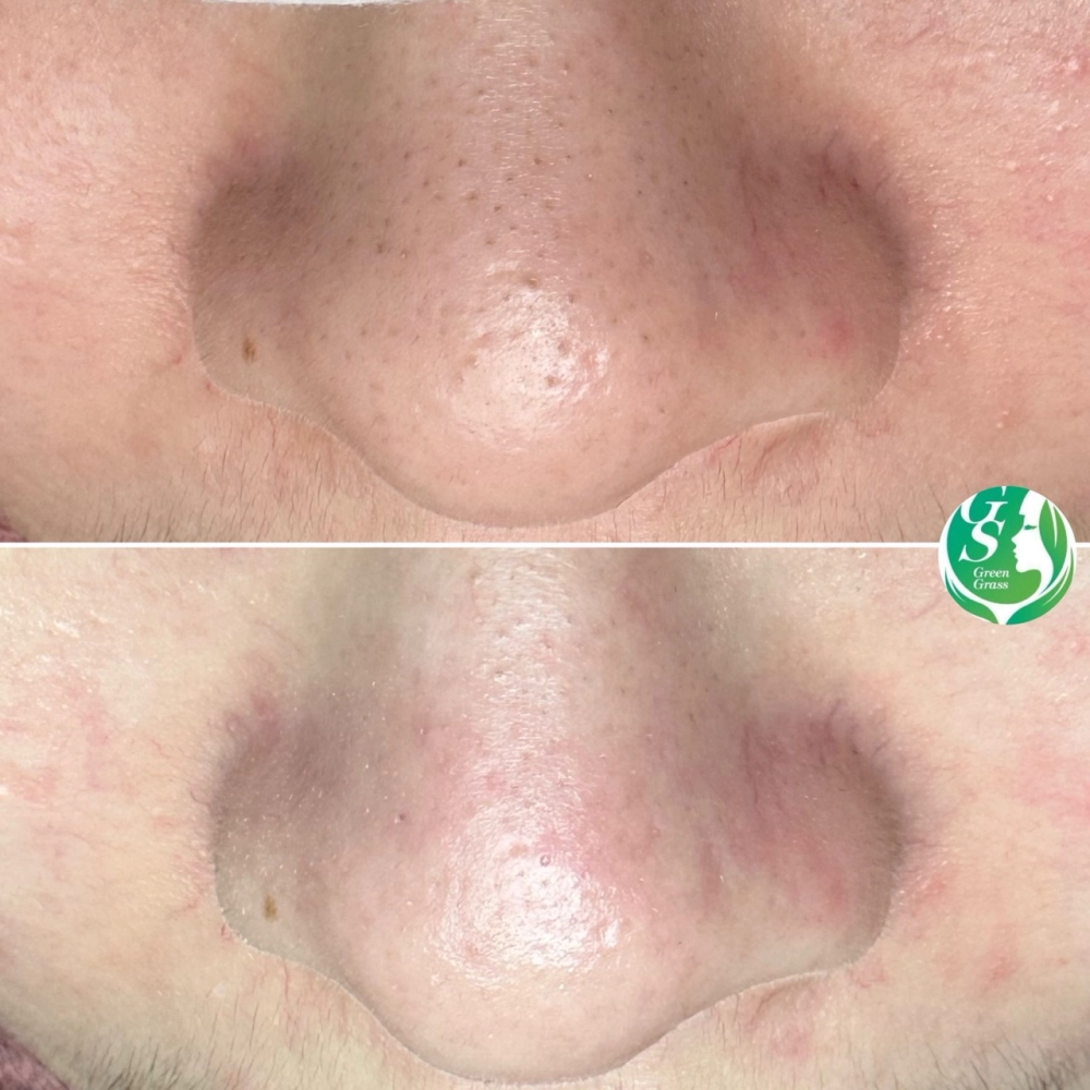 臉部保養｜桃園做臉、桃園做臉推薦