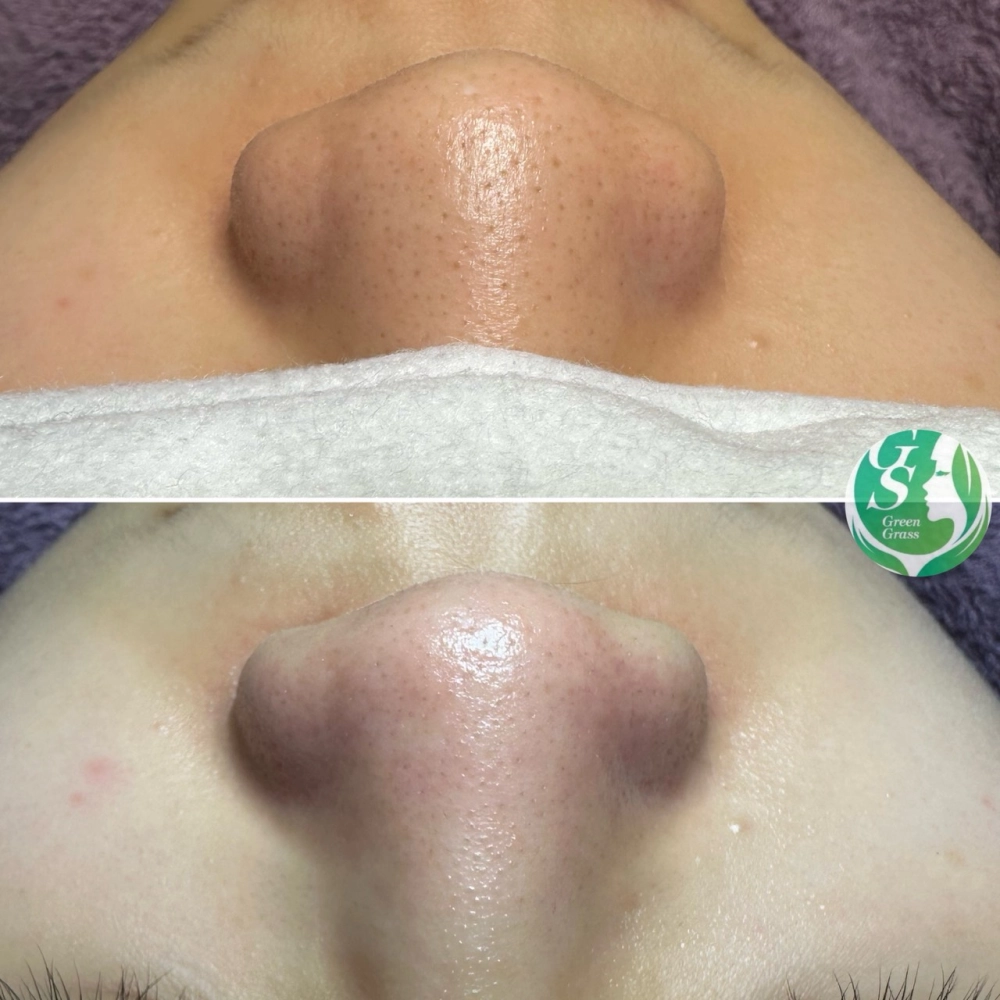 臉部保養｜桃園做臉、桃園做臉推薦