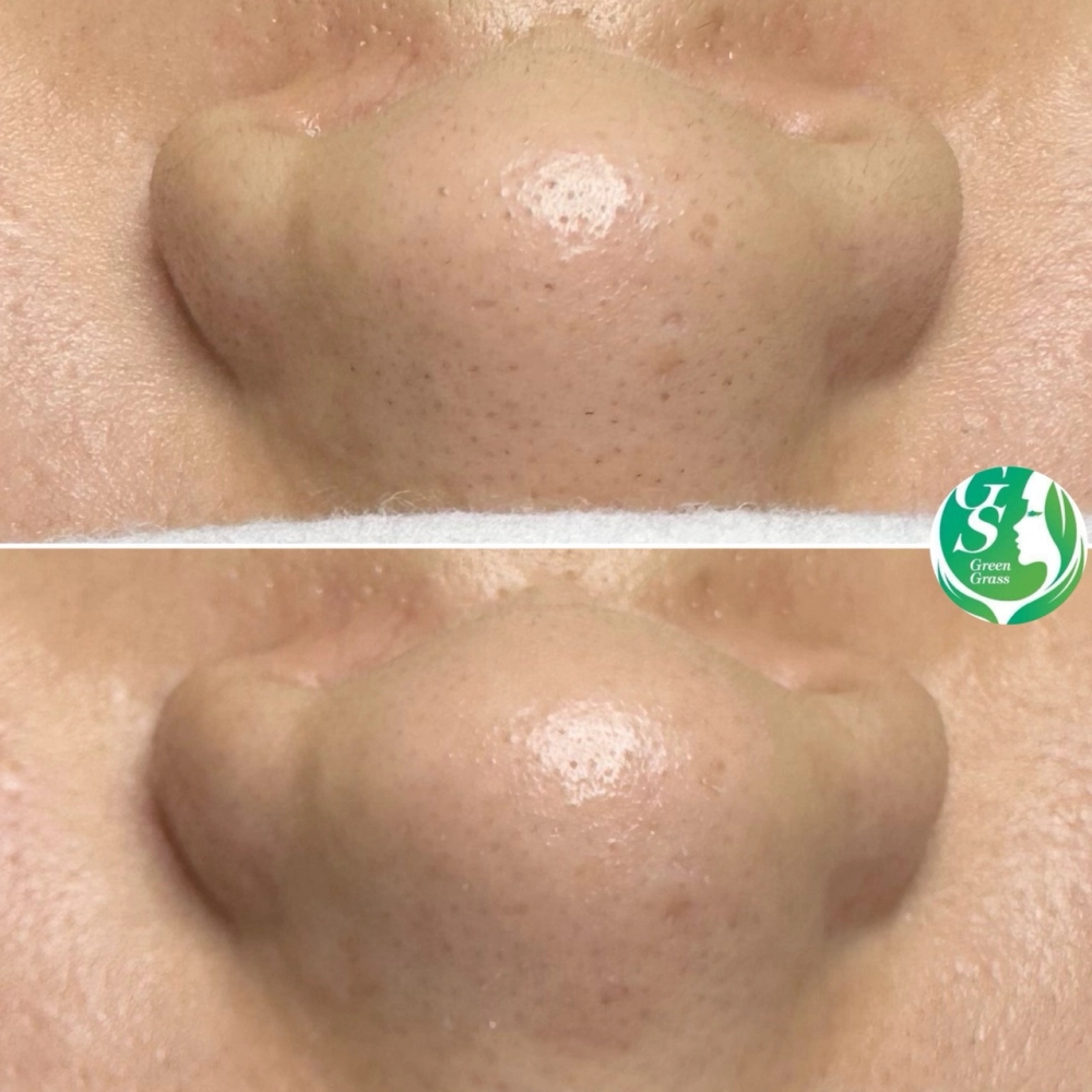 臉部保養｜桃園做臉、桃園做臉推薦