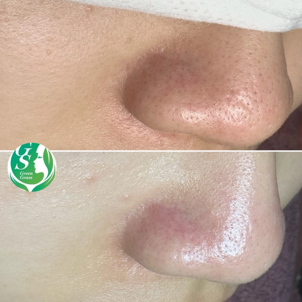 臉部保養｜桃園做臉、桃園做臉推薦