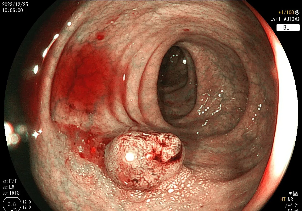 『案例分享』- 隱藏在大腸息肉中的大腸癌