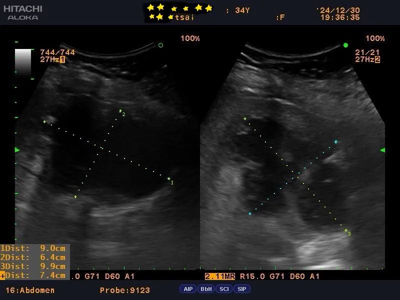 『案例分享』-肝膿瘍 是什麼?