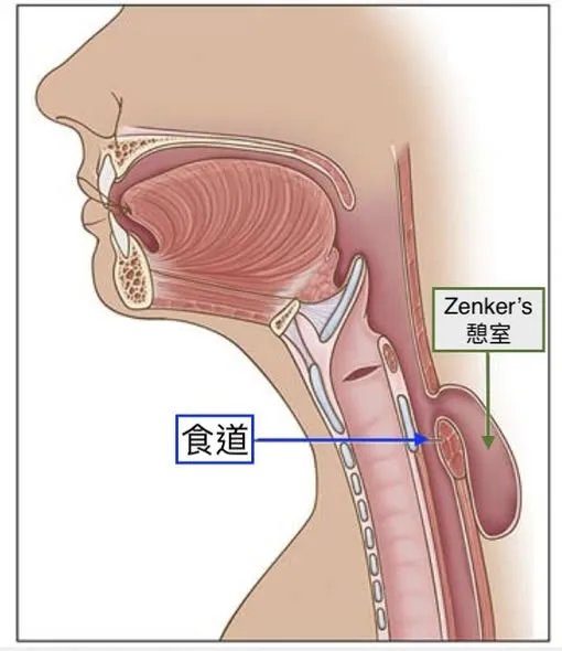 『案例分享』-食道憩室