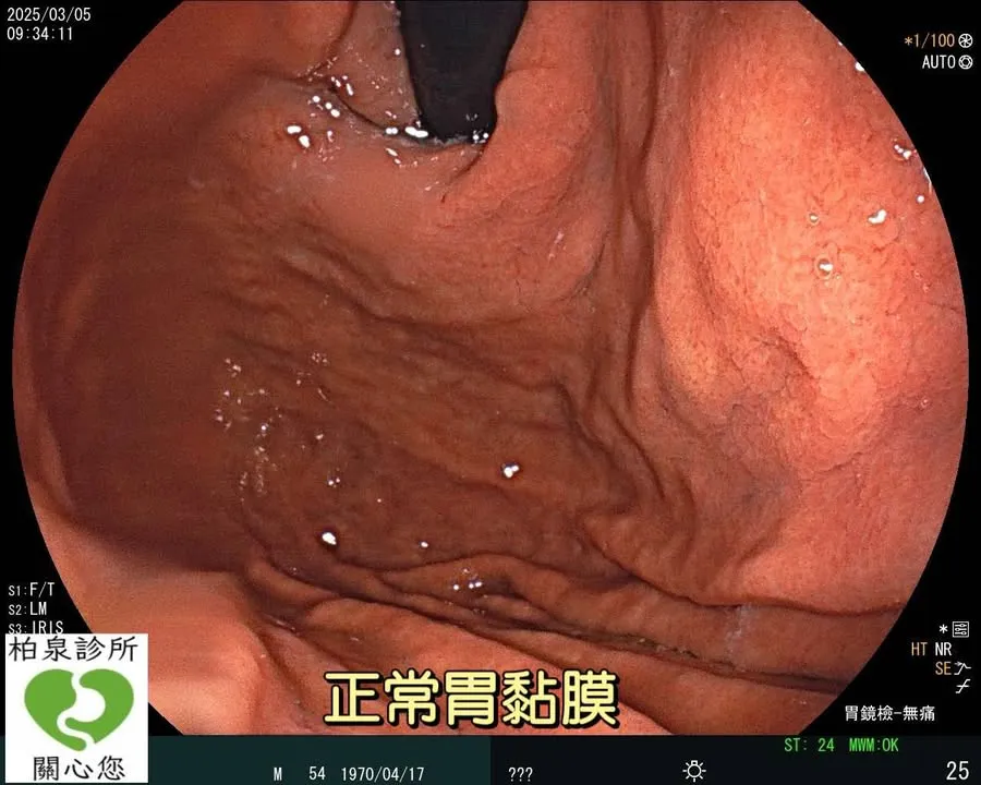 『案例分享』-幽門螺旋桿菌