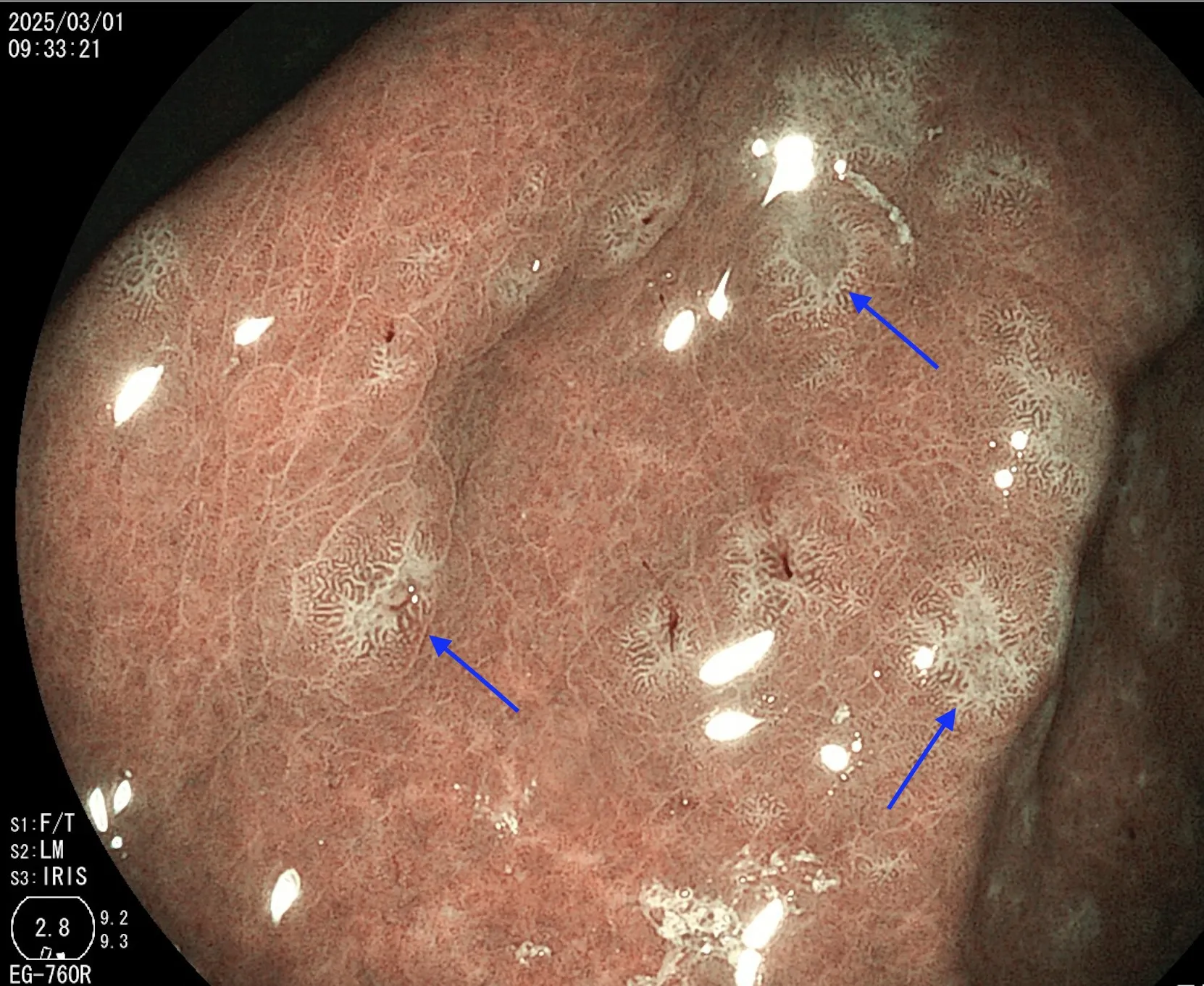 『案例分享』-腸上皮化生