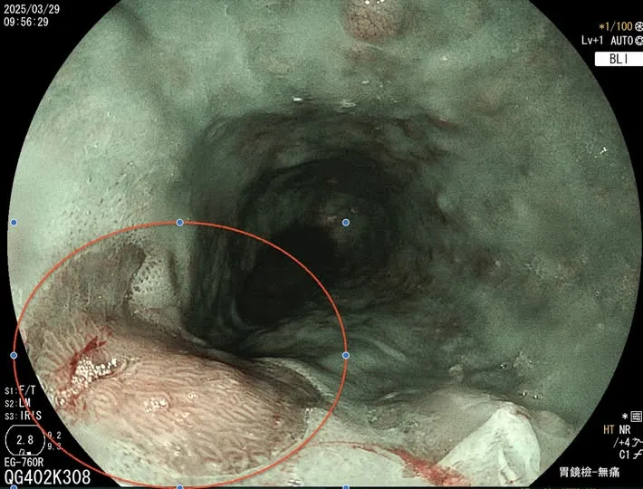 『案例分享』-食道胃黏膜異位