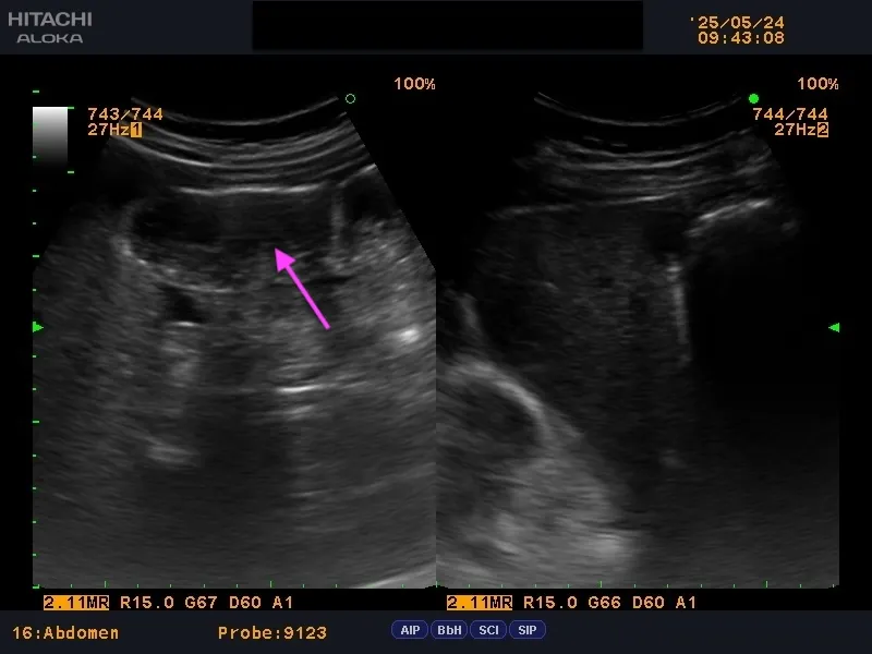 『案例分享』-急性腹痛
