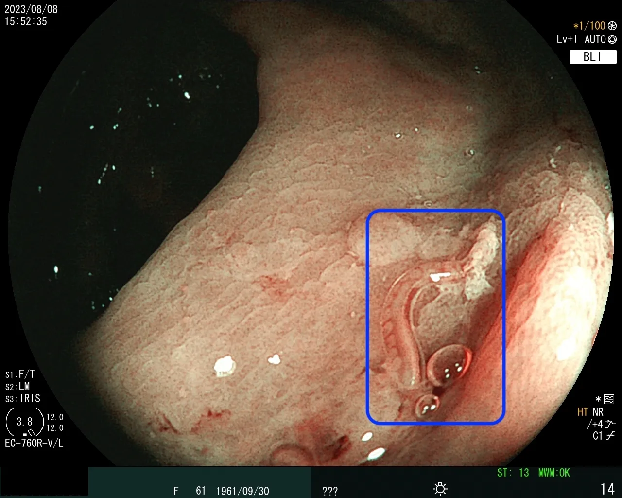 『案例分享』-腸道寄生蟲
