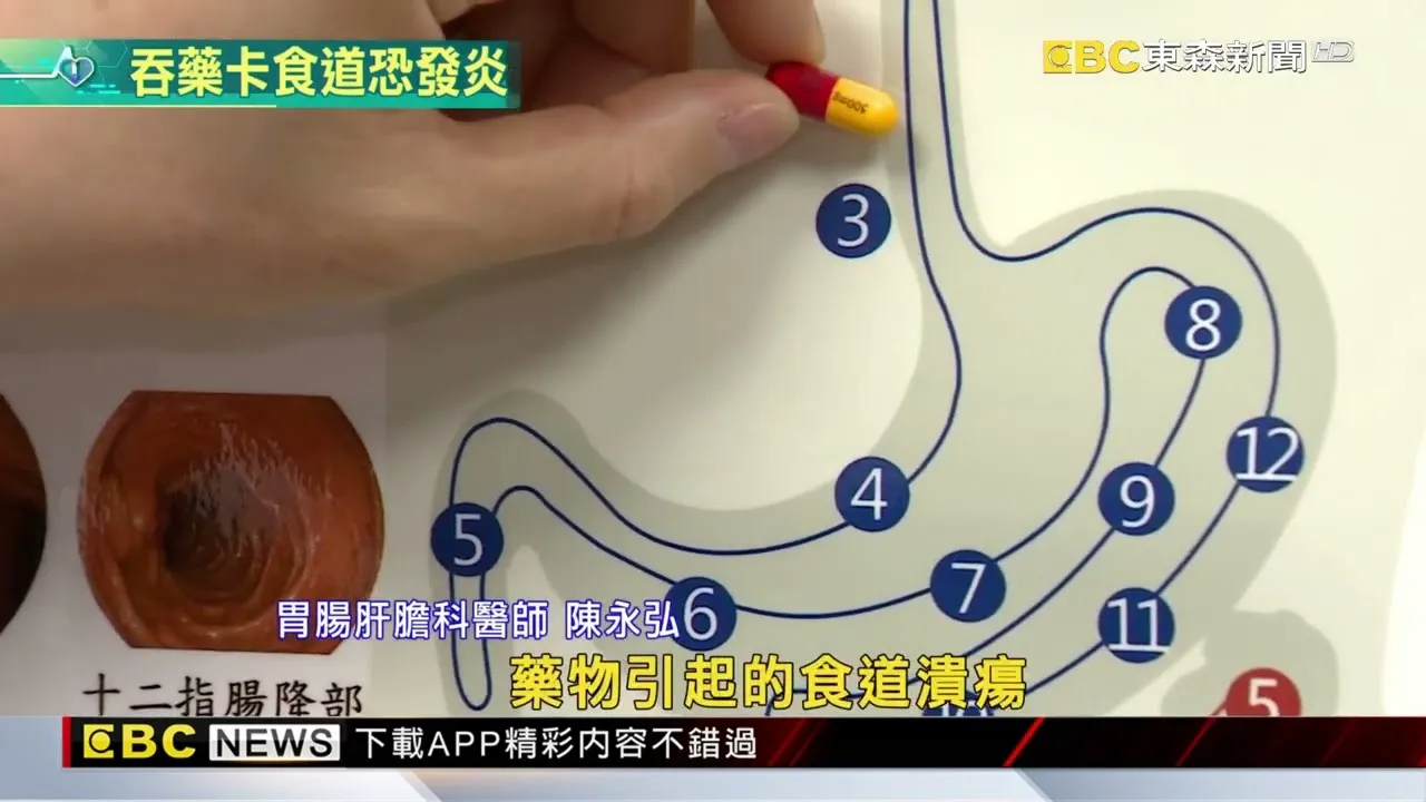 吞藥注意！ 「藥物食道炎」抗生素.止痛藥最容易發生 ‪@newsebc‬
