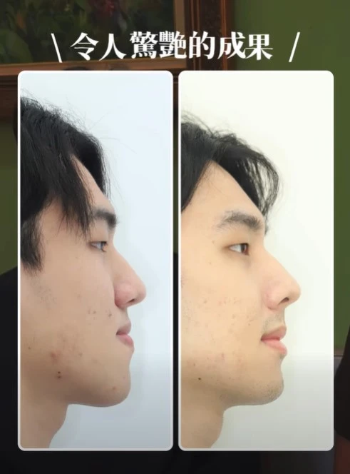 隱適美矯正X正顎手術