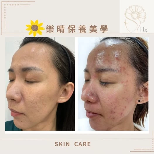 痘痘肌每天的保養功課