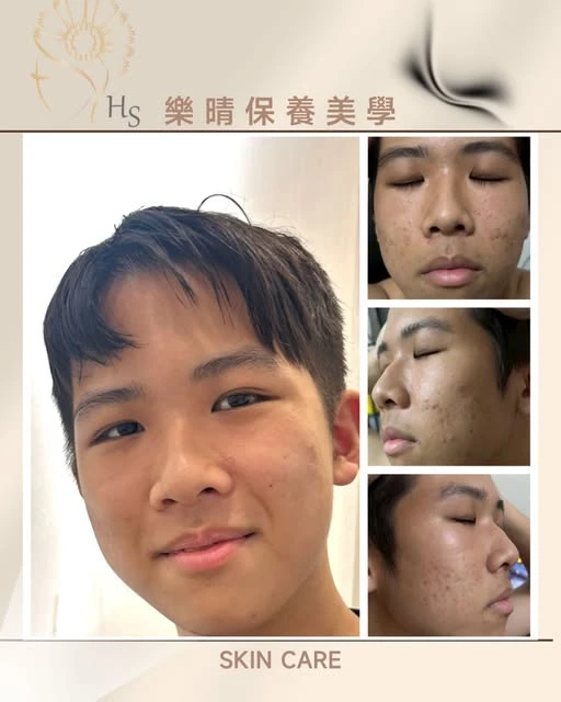 你的孩子，也正在經歷青春期的肌膚困擾嗎？