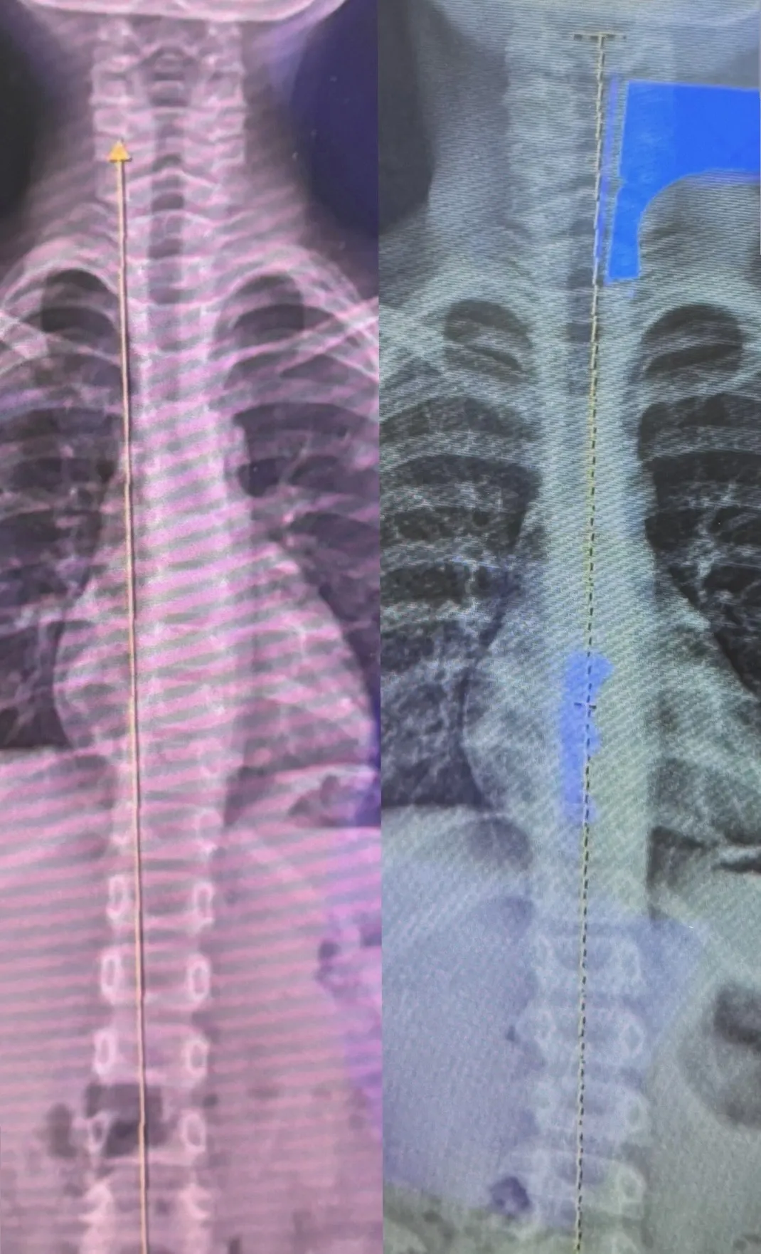物理治療Ｘ兒童姿勢介入之成效｜南投物理治療｜草屯物理治療