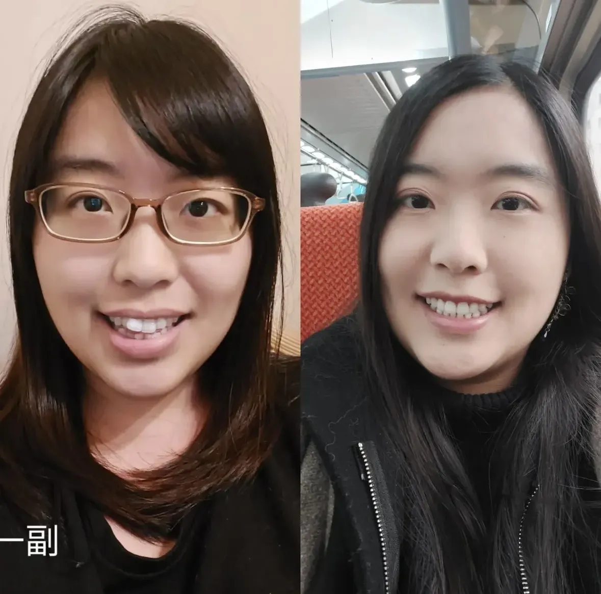 牙齒矯正完成✨️人生最值得的決定之一！