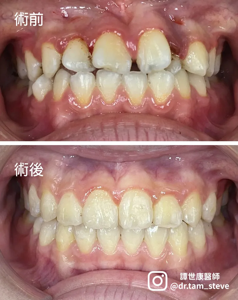 牙齒不齊 / 隱適美