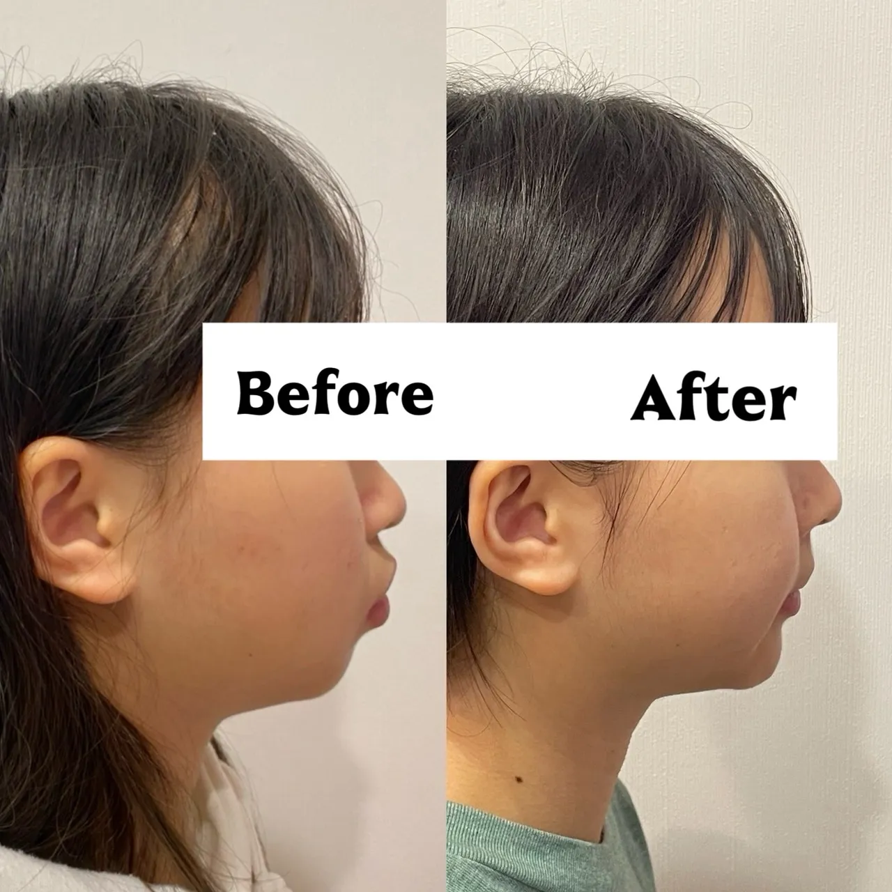 縮臉效果/拔四顆小臼齒