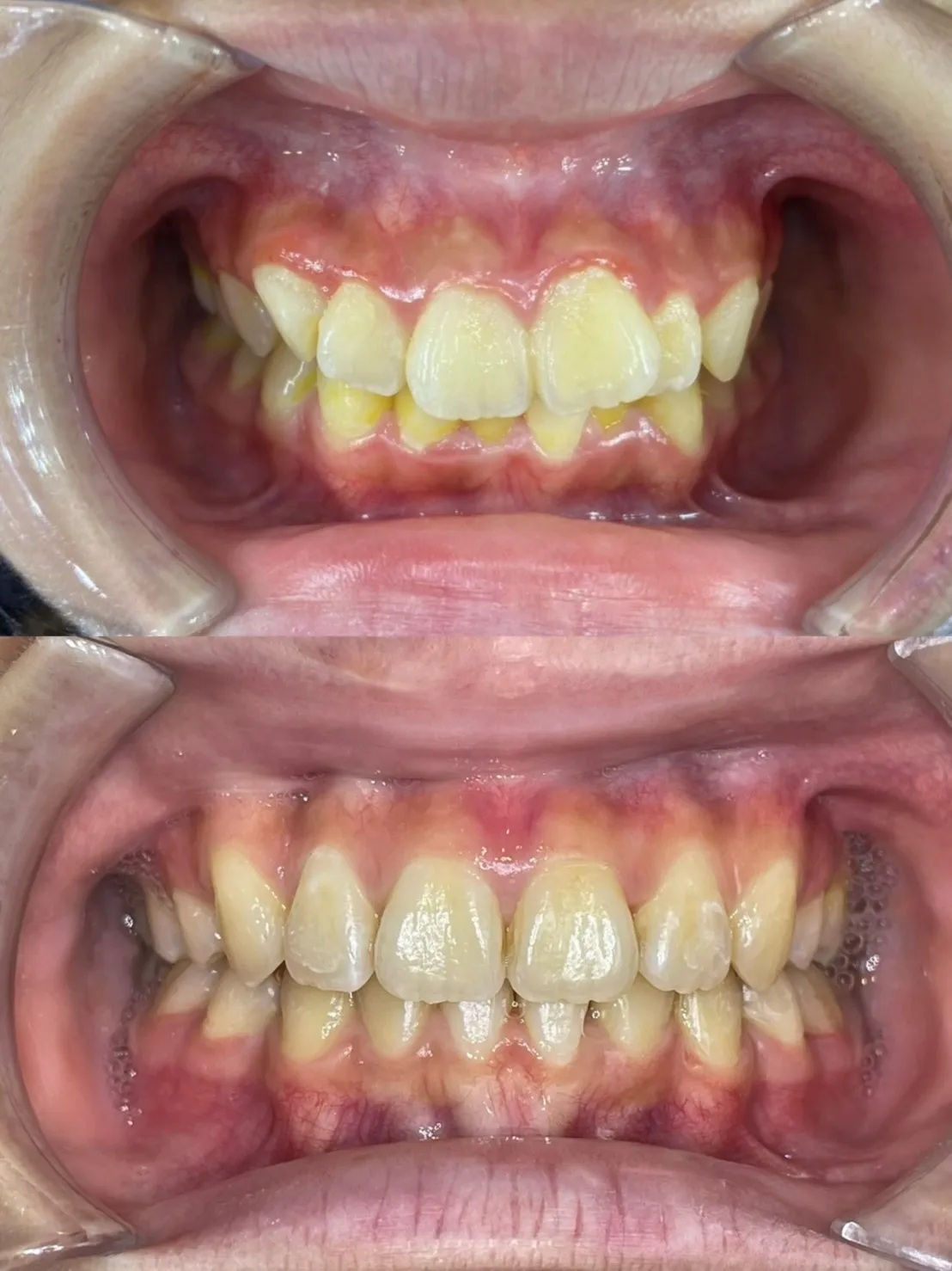 縮臉效果/拔四顆小臼齒