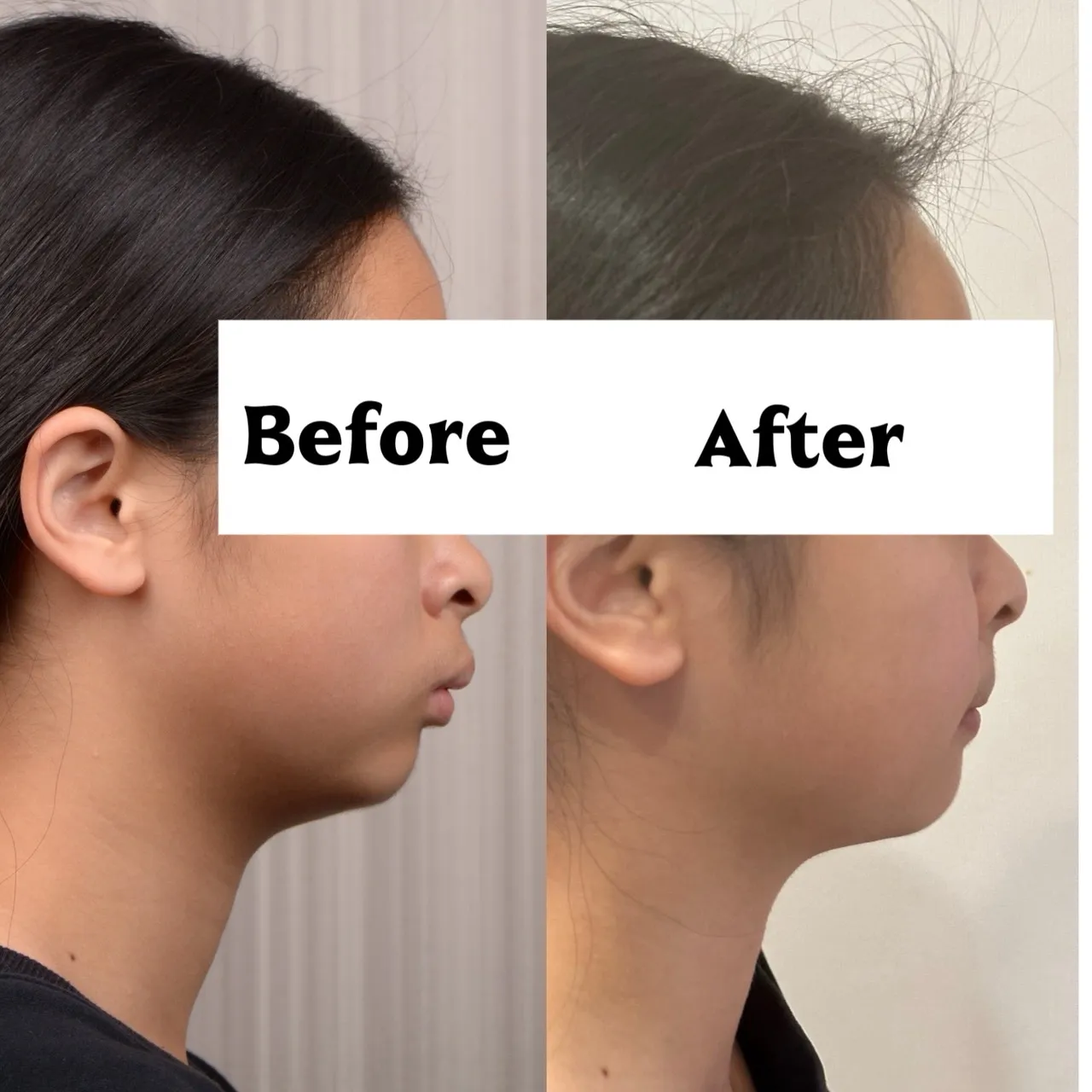 縮臉效果/拔上排兩顆小臼齒