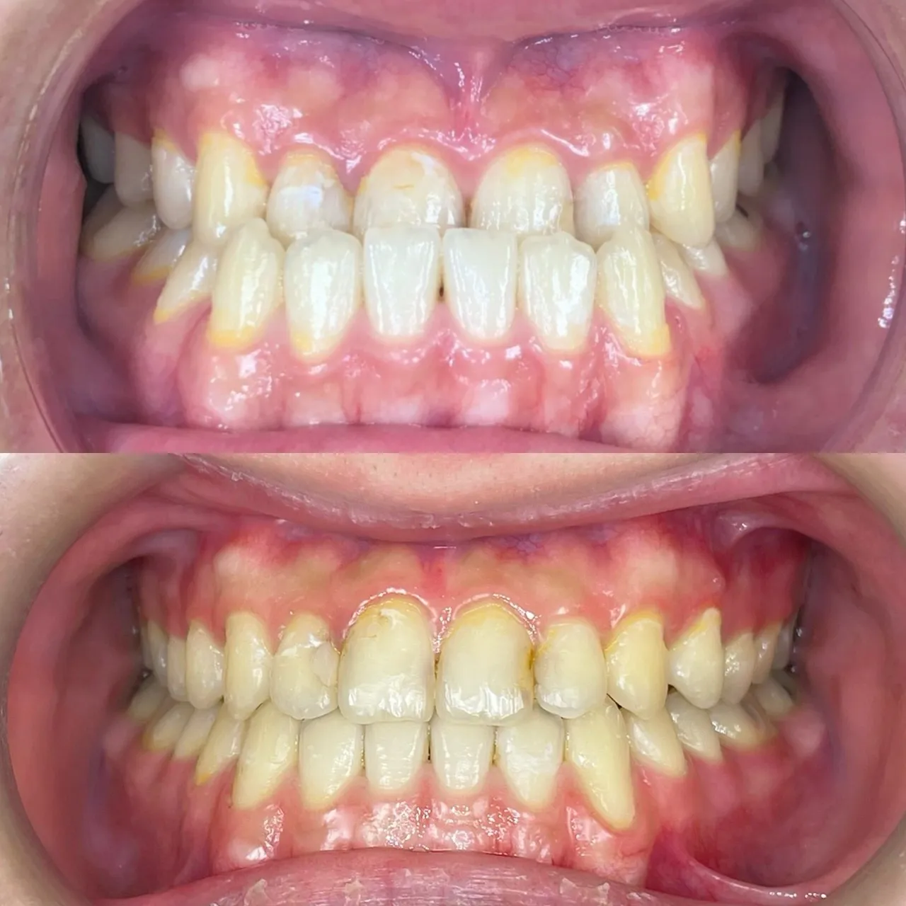 戽斗/沒有做正顎手術