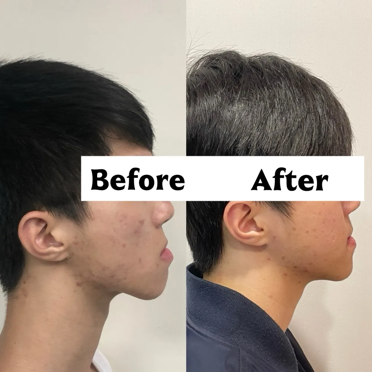 戽斗/沒有做正顎手術