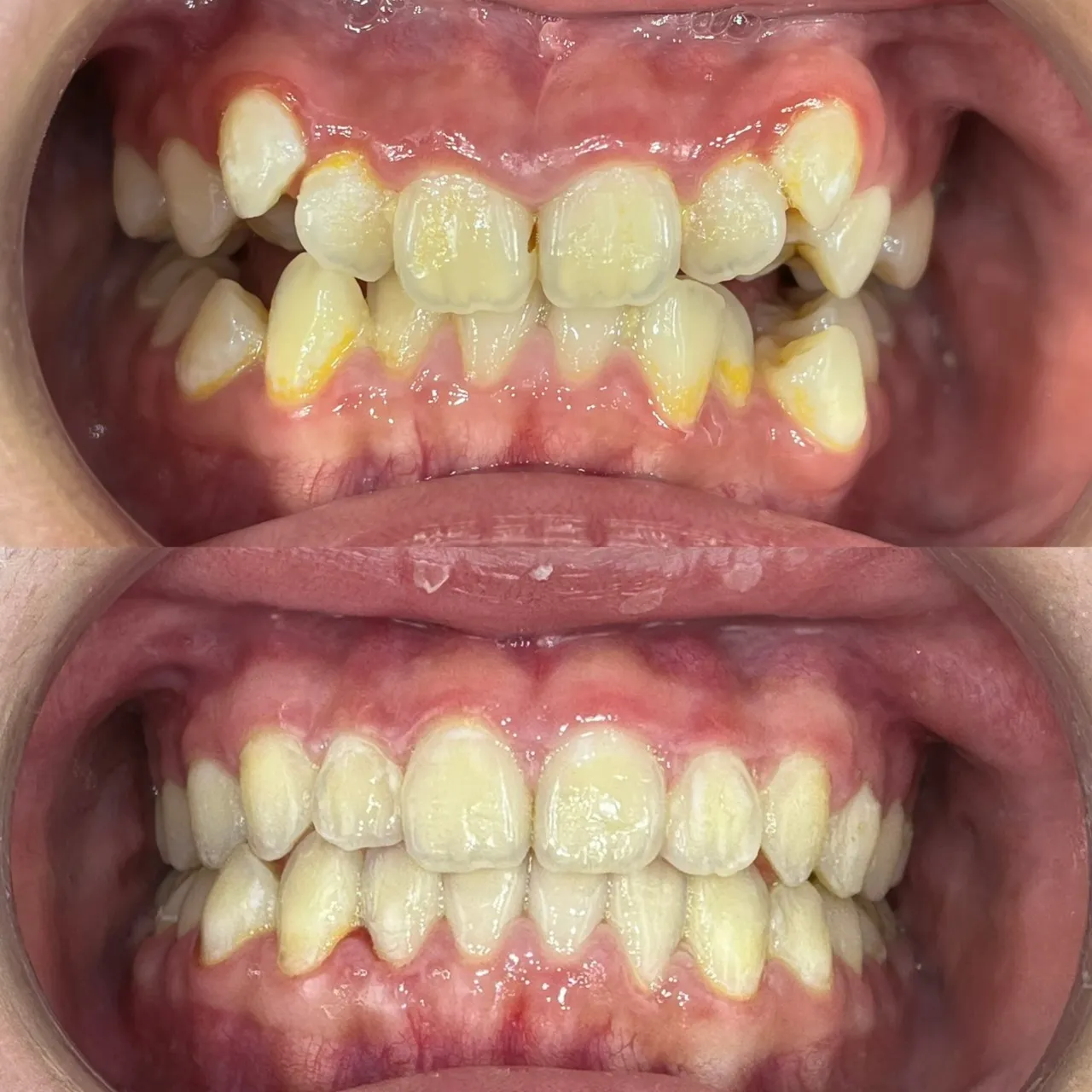 虎牙高位/咬合異常與排列問題
