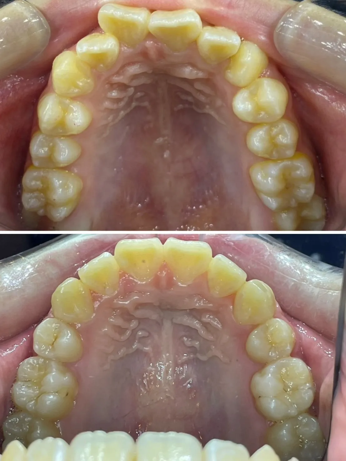 縮臉效果/拔四顆小臼齒