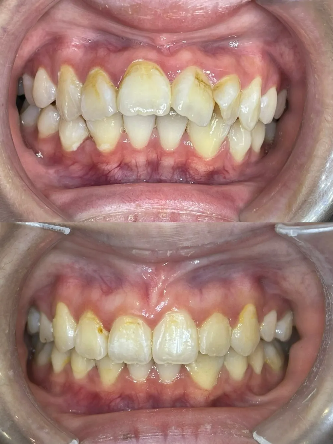 縮臉效果/拔上排兩顆小臼齒