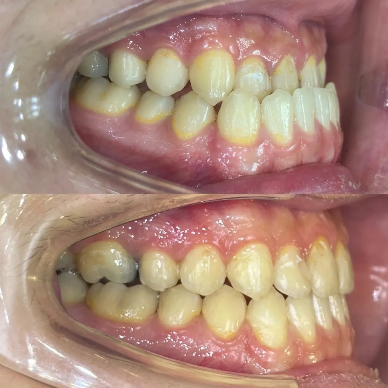 戽斗/沒有做正顎手術