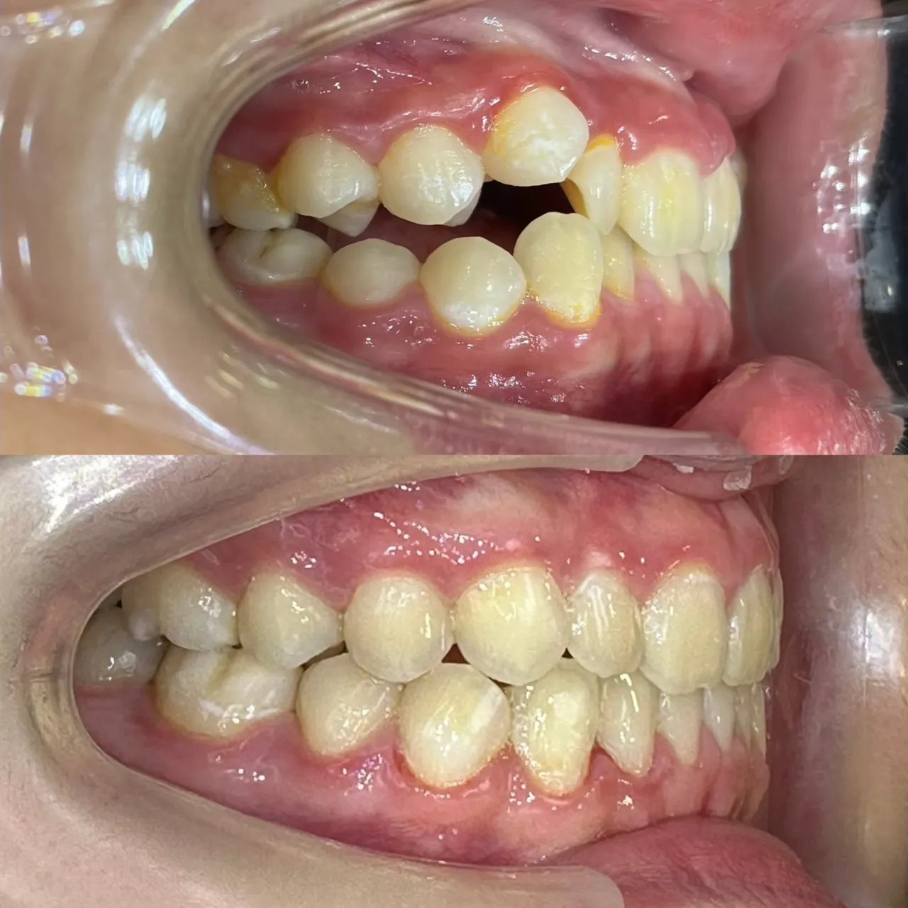 虎牙高位/咬合異常與排列問題