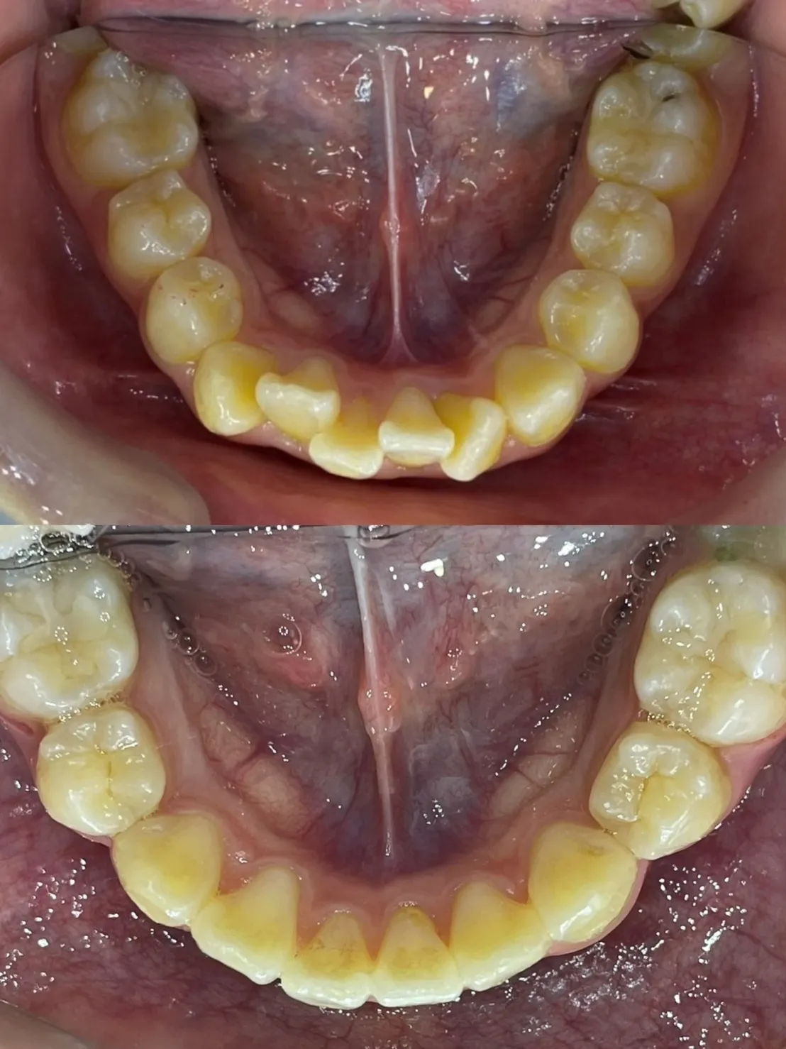 縮臉效果/拔四顆小臼齒