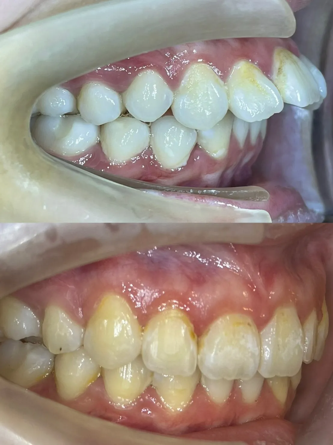 縮臉效果/拔上排兩顆小臼齒