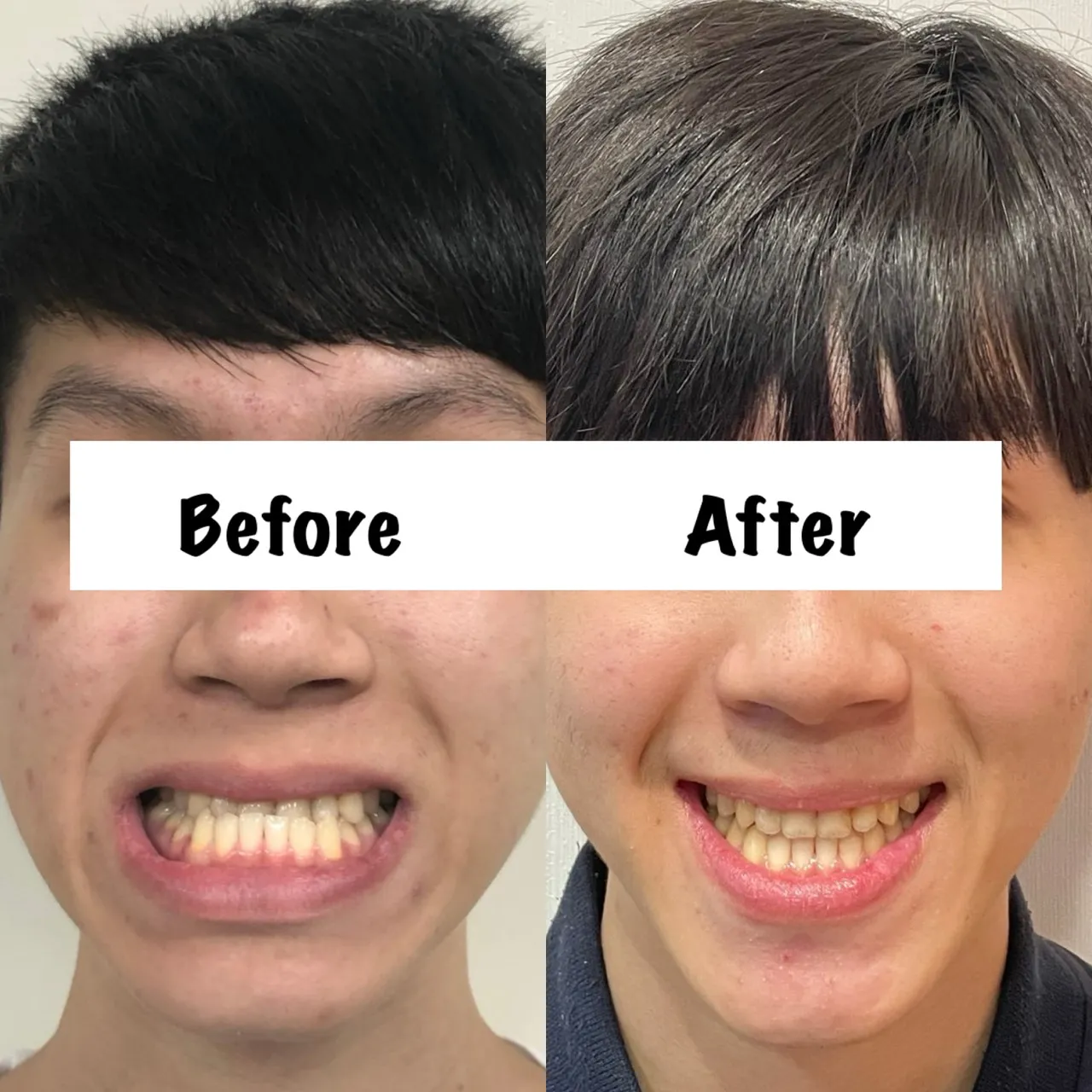 戽斗/沒有做正顎手術