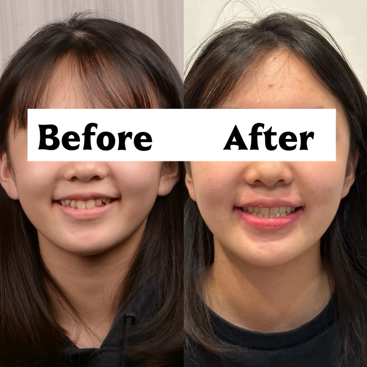 虎牙高位/咬合異常與排列問題