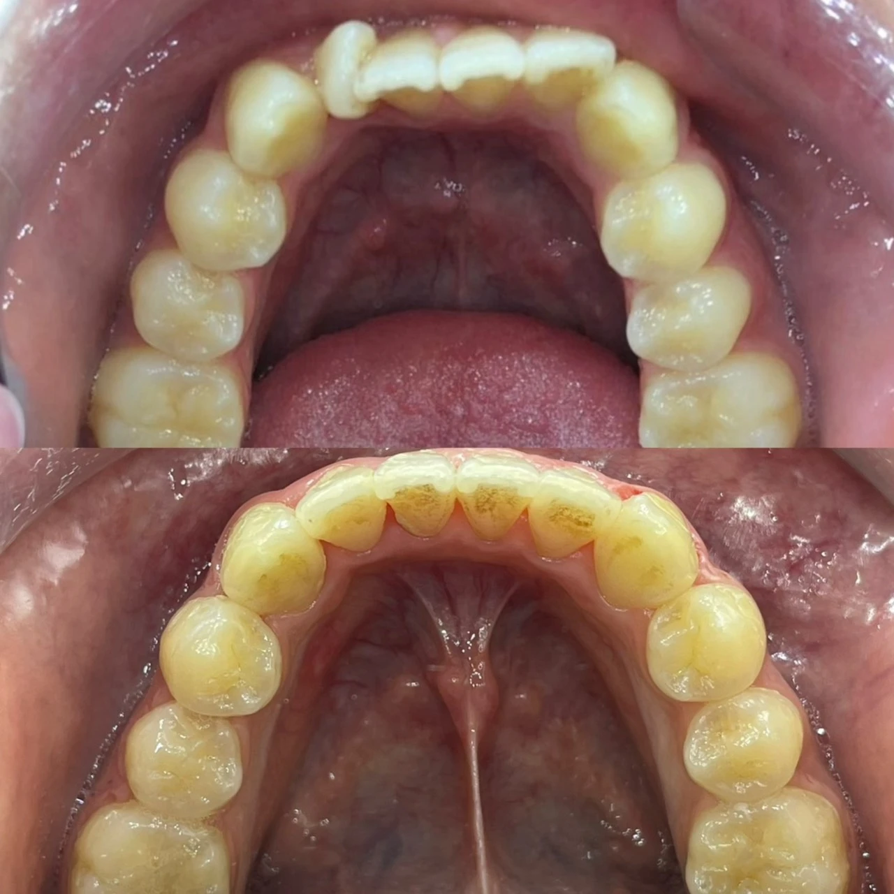 右下側門牙旋轉 - 桃園牙套 | 桃園矯正推薦