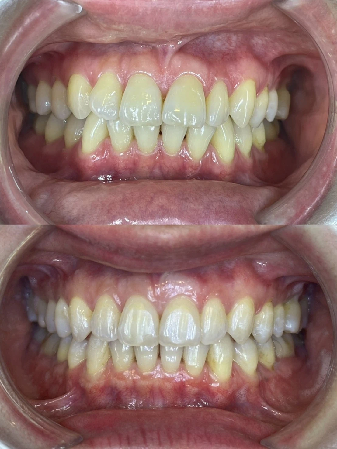 咬合調整、齒列不整 -桃園隱形矯正  | 桃園隱適美
