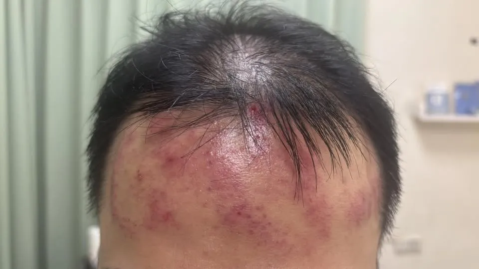 頭脹脹的怎麼辦? 溫罐｜新竹溫罐