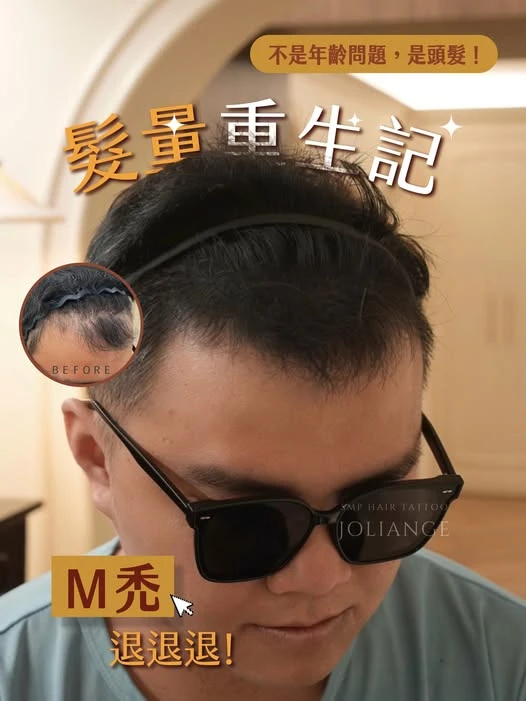 不是年紀讓你看起來累… 是髮際線悄悄後退了