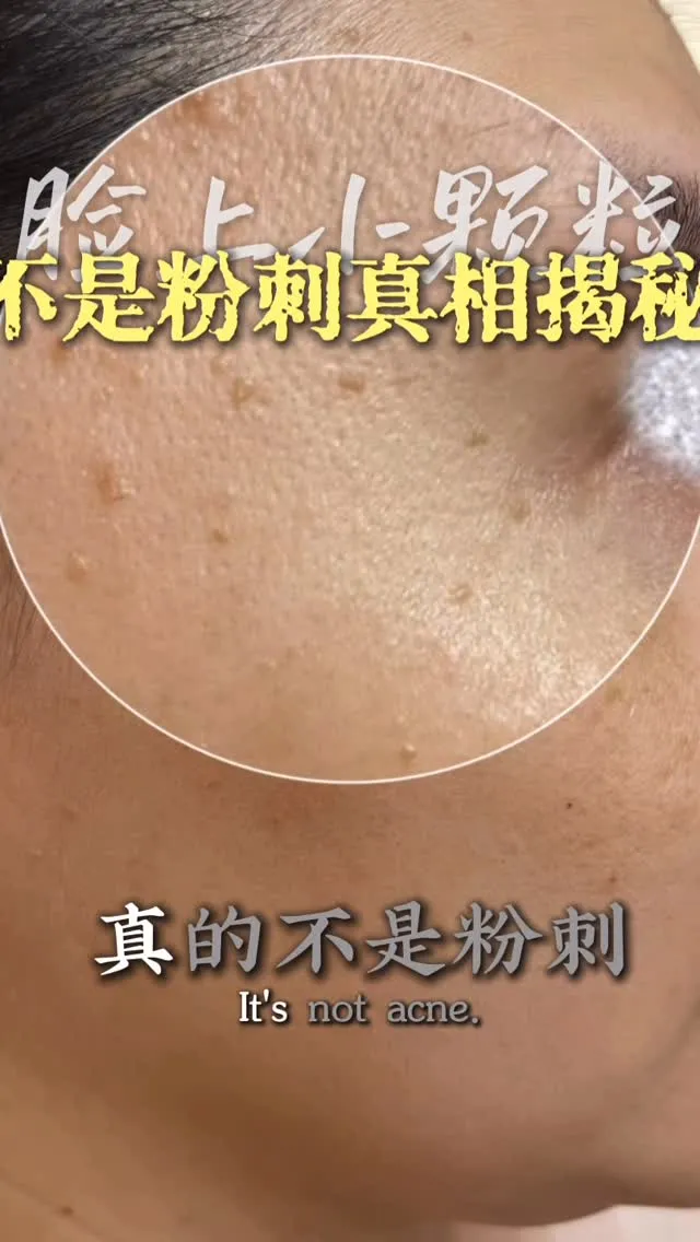 臉上粗粗的小顆粒擠不出？解析眼周、脖子粉刺原因與處理方法｜台北做臉｜汐止做臉