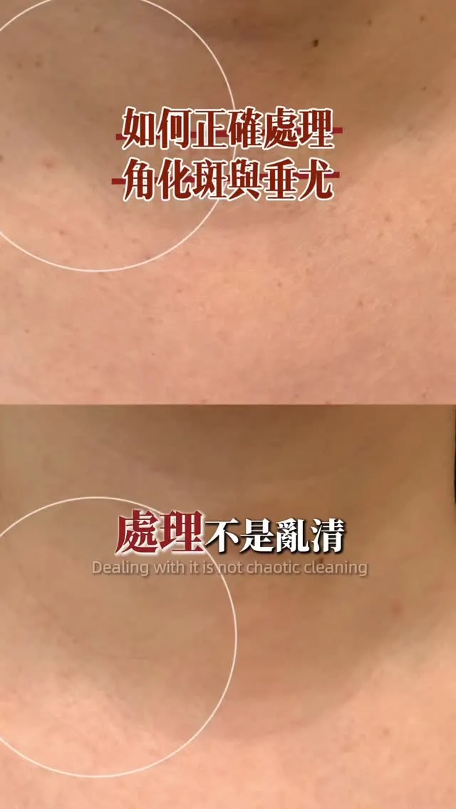 角化斑 & 垂尤真的會長？成因、症狀與改善方法總整理｜台北做臉推薦｜汐止做臉推薦