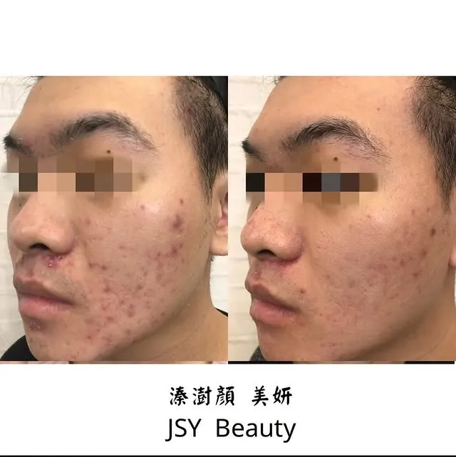 青春期長期有痘痘皮膚問題困擾，嘗試過皮膚科、其他工作室處理都未能得到改善｜台北痘痘肌處理｜汐止痘痘肌處理